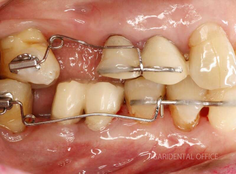 Orthodontic MINISCREW Implants 歯列矯正