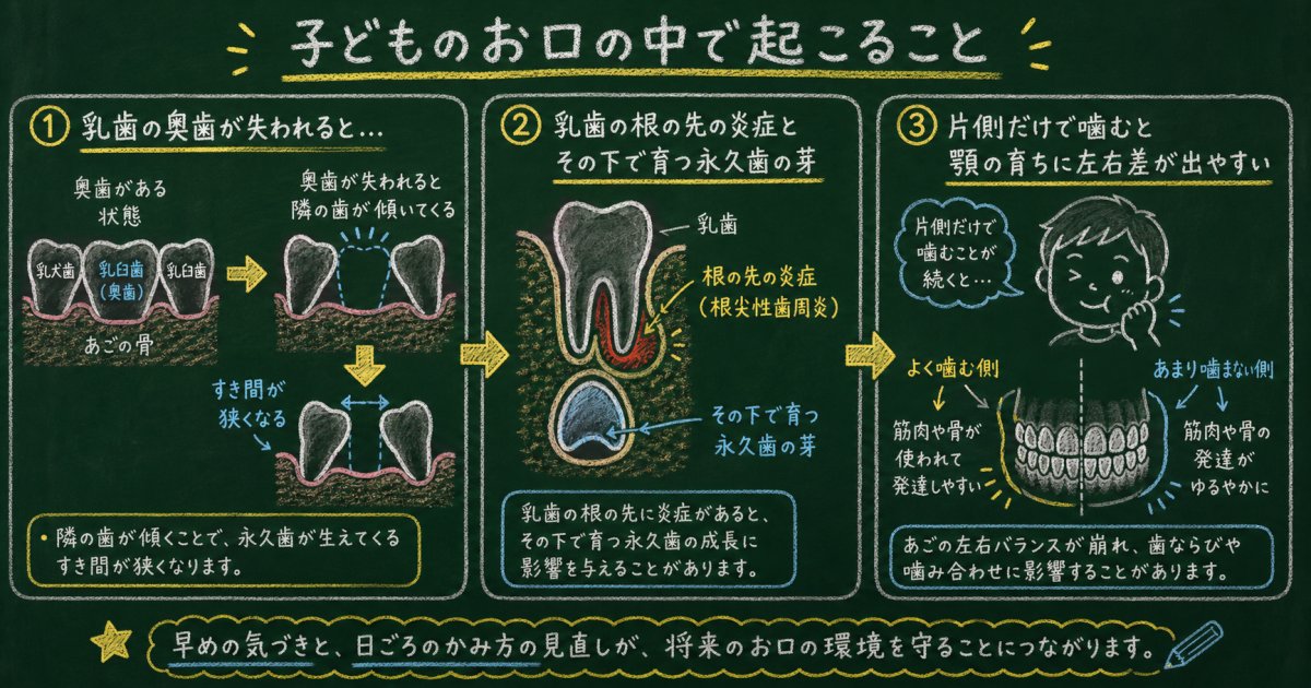 乳歯のむし歯が永久歯の歯並びに影響を与える3つの理由