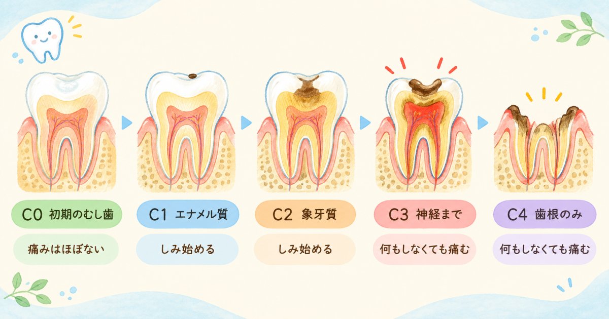C0からC4まで、むし歯の進行段階と見た目・症状の変化